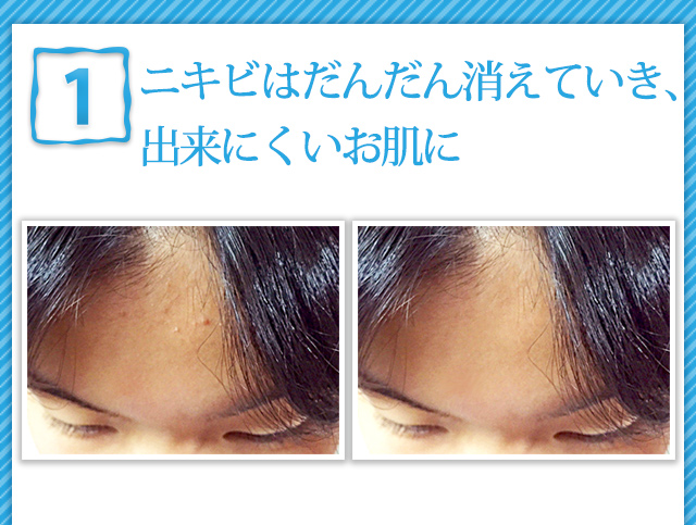 1ニキビはだんだん消えていき、出来にくいお肌に